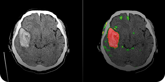 BRAIN CT
