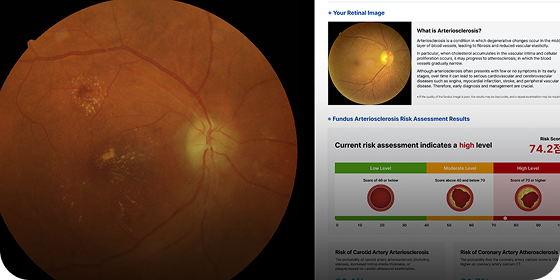 RETINAL ANALYSIS
