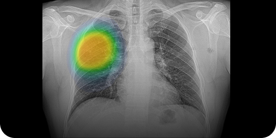 CHEST X-RAY