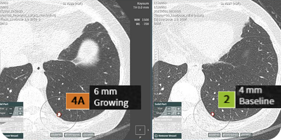 LUNG CT