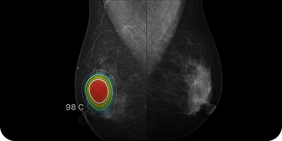 MAMMOGRAPHY / DBT